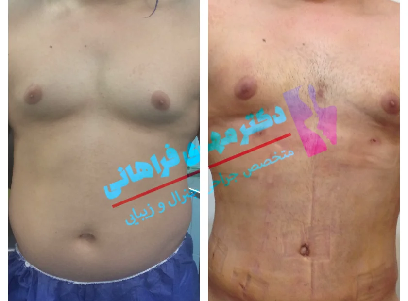 لیپو-ساکشن-ابدو-1