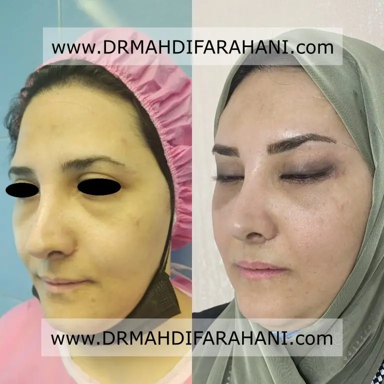 لیفت شقیقه با دکتر مهدی فراهانی