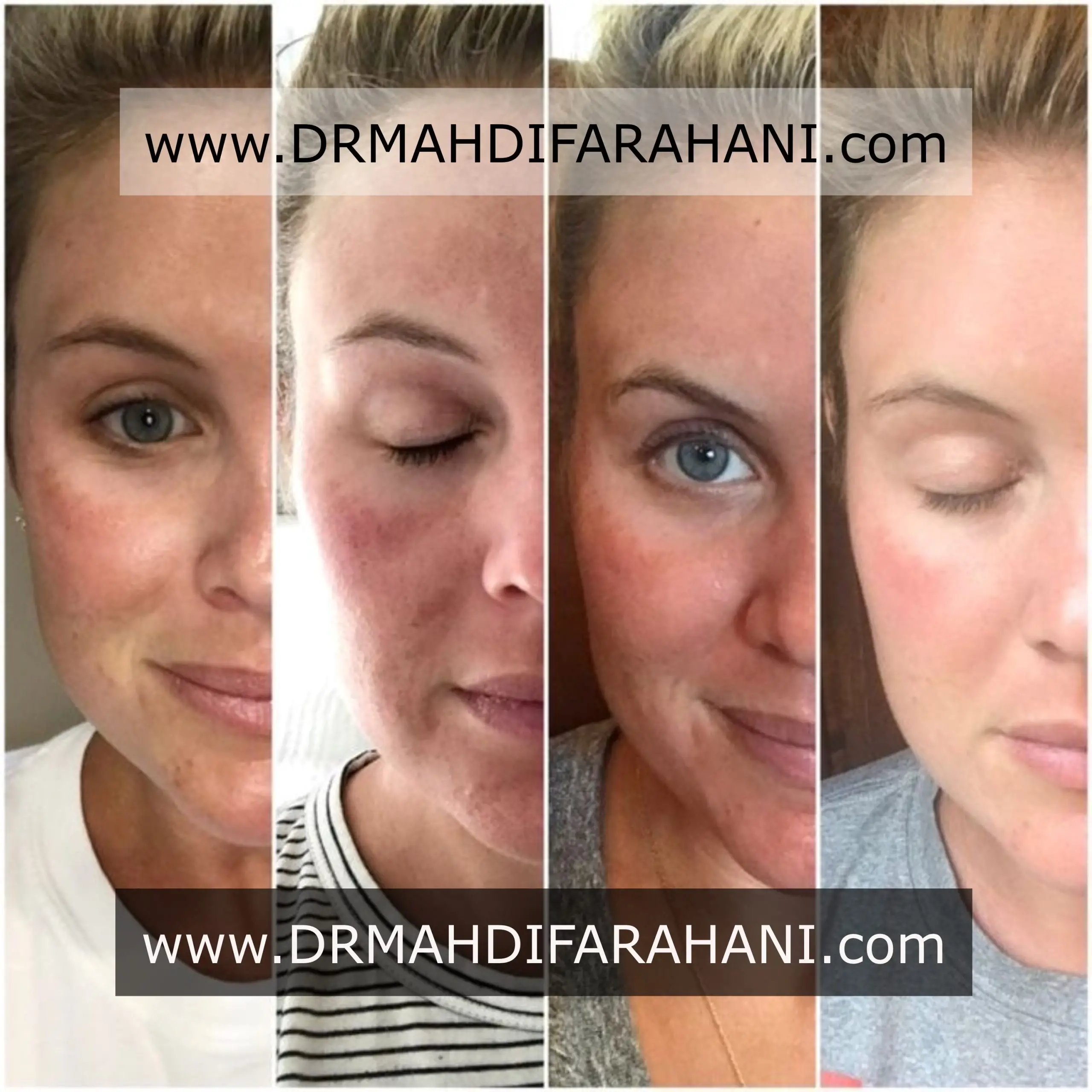 میکرونیدلینگ با دکتر مهدی فراهانی